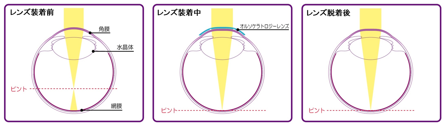 オルソケラトロジーの矯正メカニズム1